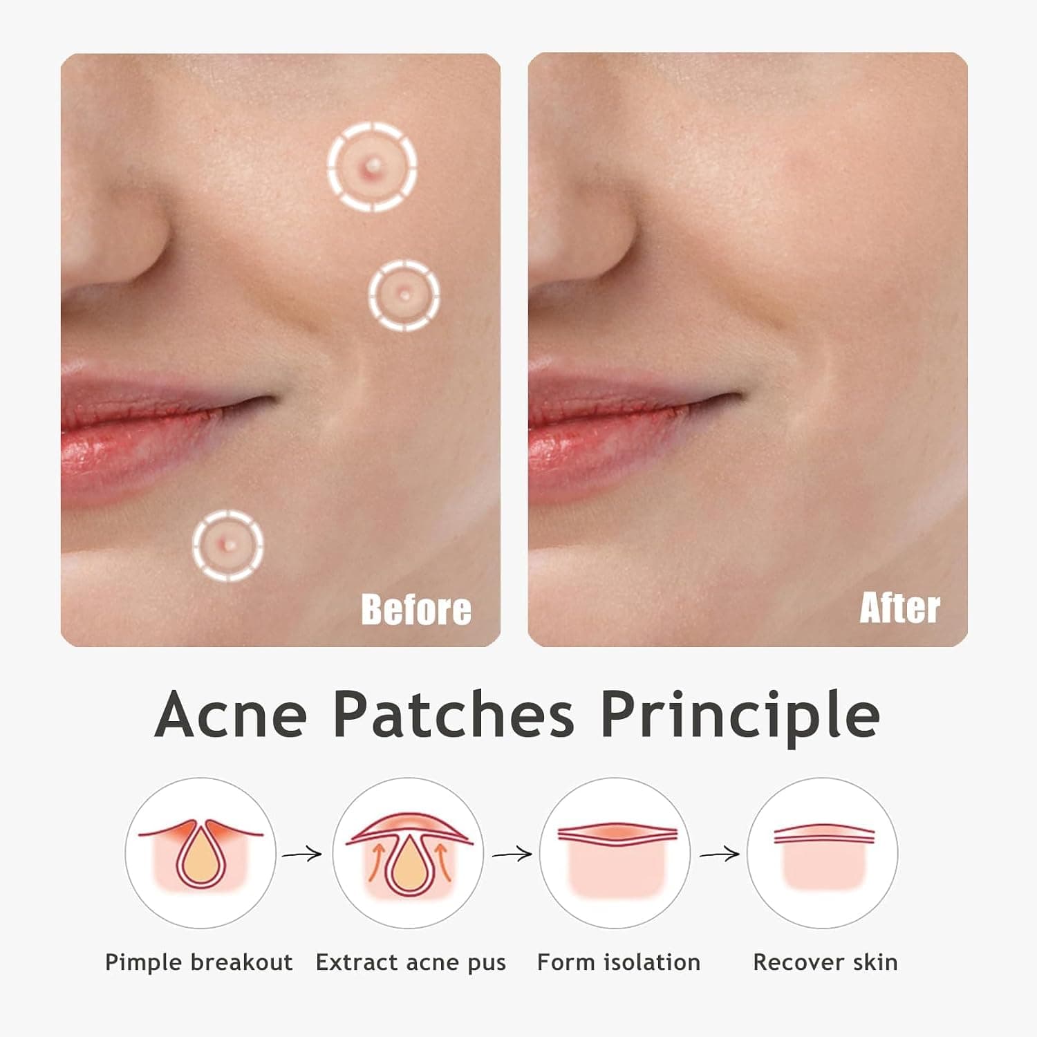 Dazzlook Ultra Pimple Patches 48-Count Hydrocolloid Spot Blemish Treatment with Salicylic Acid for Invisible Day and Night Skin Absorbing Protection — 5 of 5